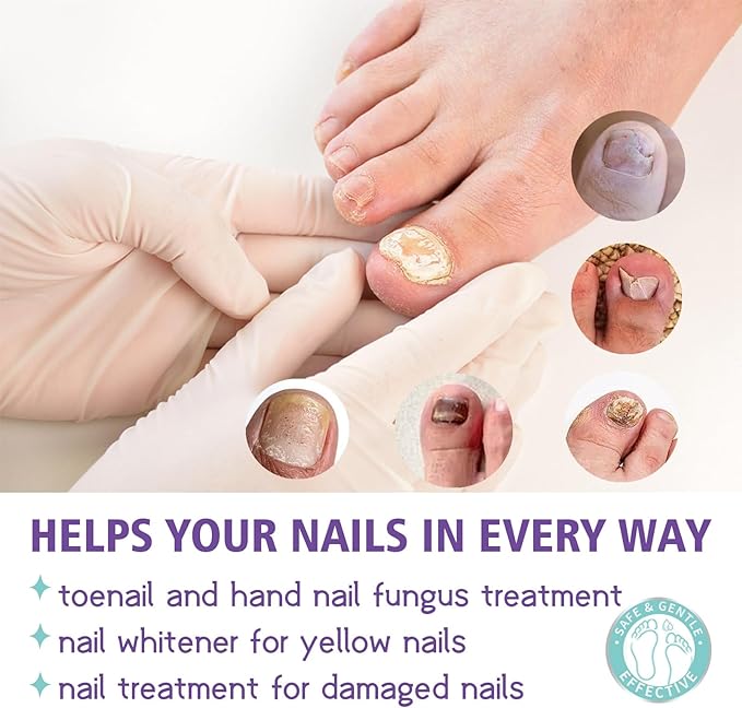 Nail Fungus Spray